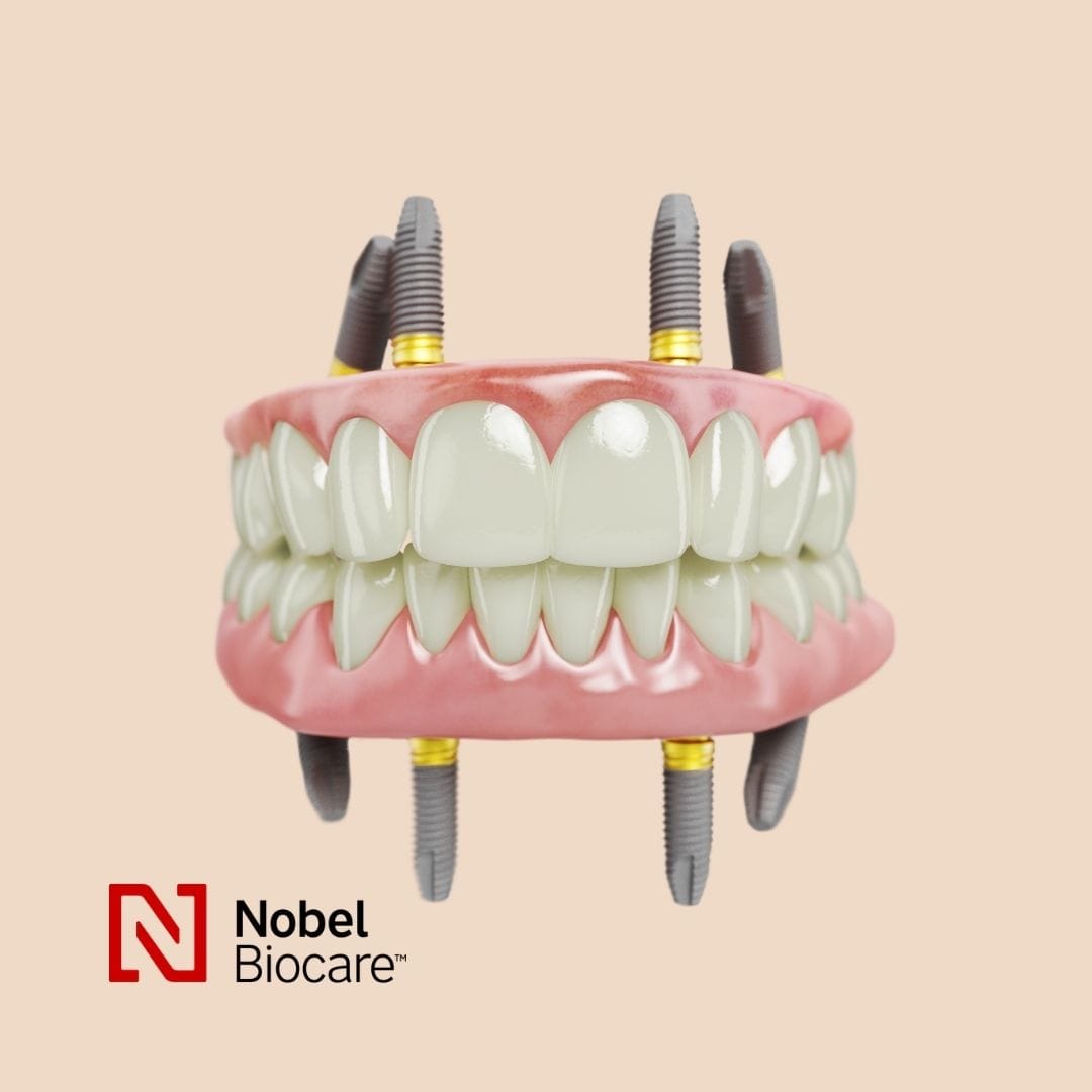 Feature Image - Why Nobel Biocare Dental Implants and Next Smile™ All-on-4® Centre Go Hand in Hand