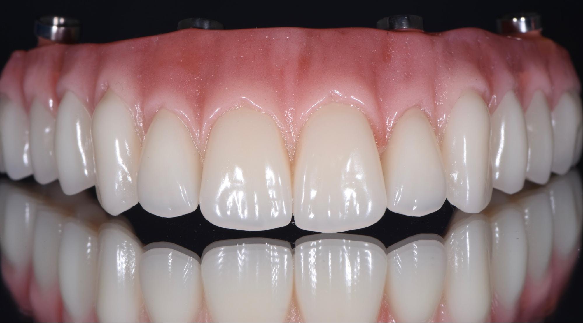 All-on-4® treatment concept vs. Dentures and Bridges | Next Smile