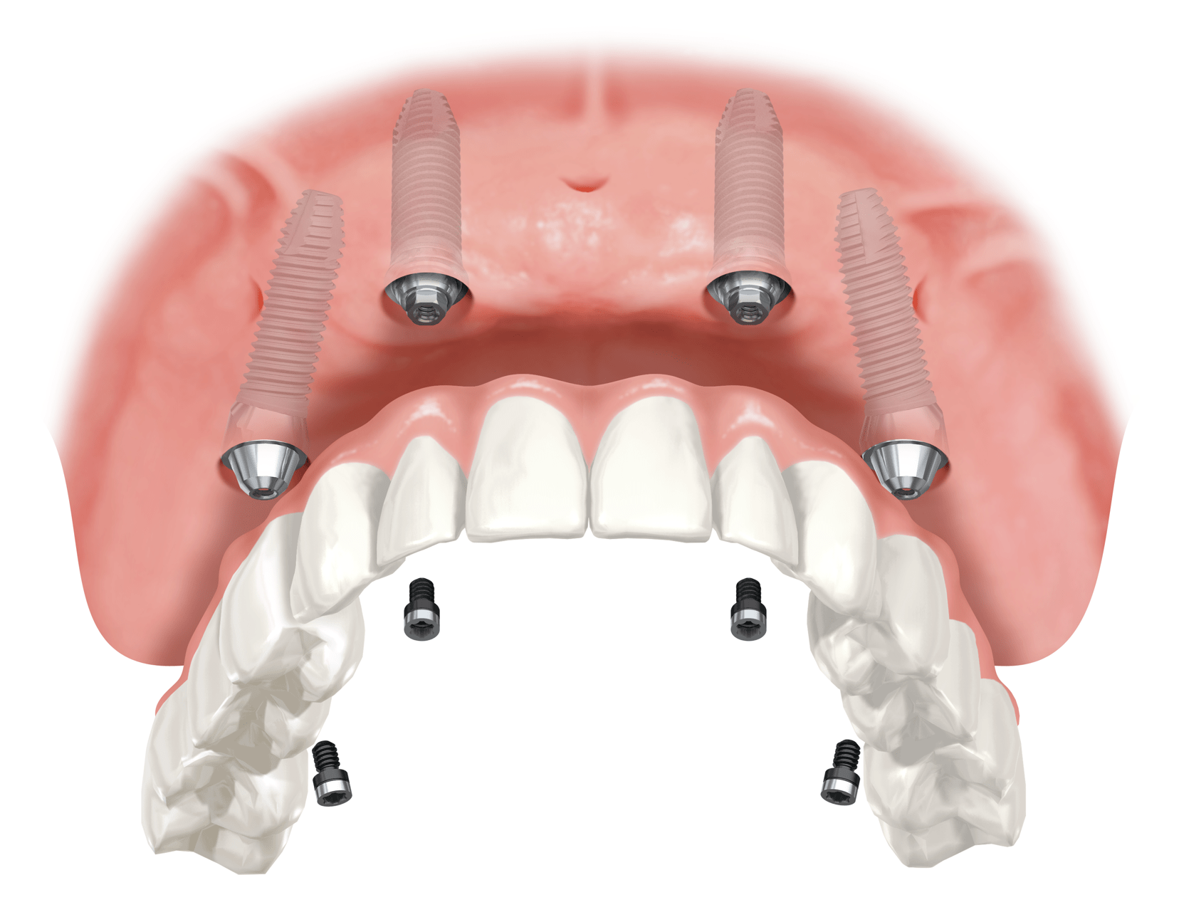 genuine-versus-non-genuine-dental-implant-components-next-smile