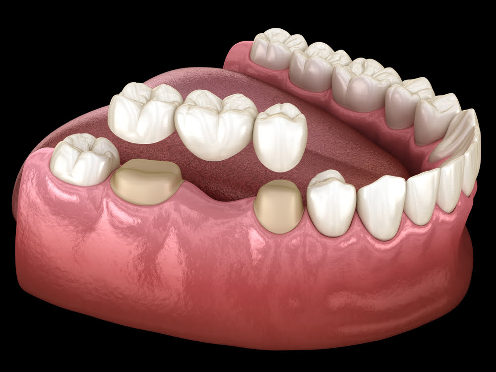 is-there-a-cheaper-alternative-to-dental-implants-next-smile