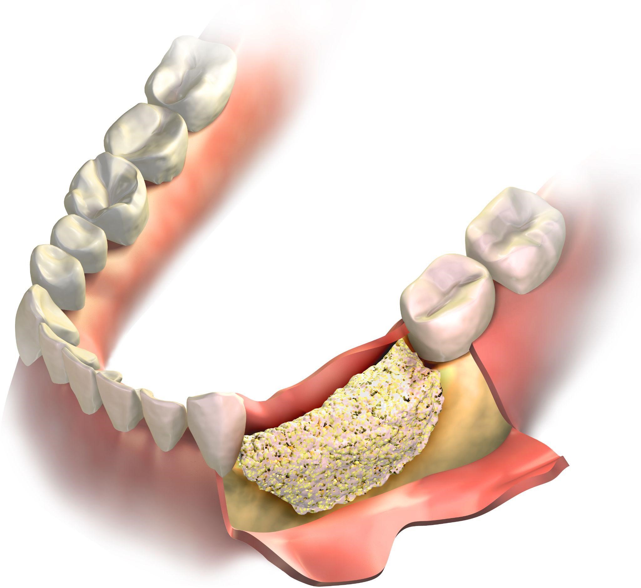 Зуб без кости. Остеопластика костной ткани челюстей. Костная пластика (остеопластика). Синус-лифтинг (костная пластика, остеопластика) закрытый. Пластика костной ткани при имплантации.