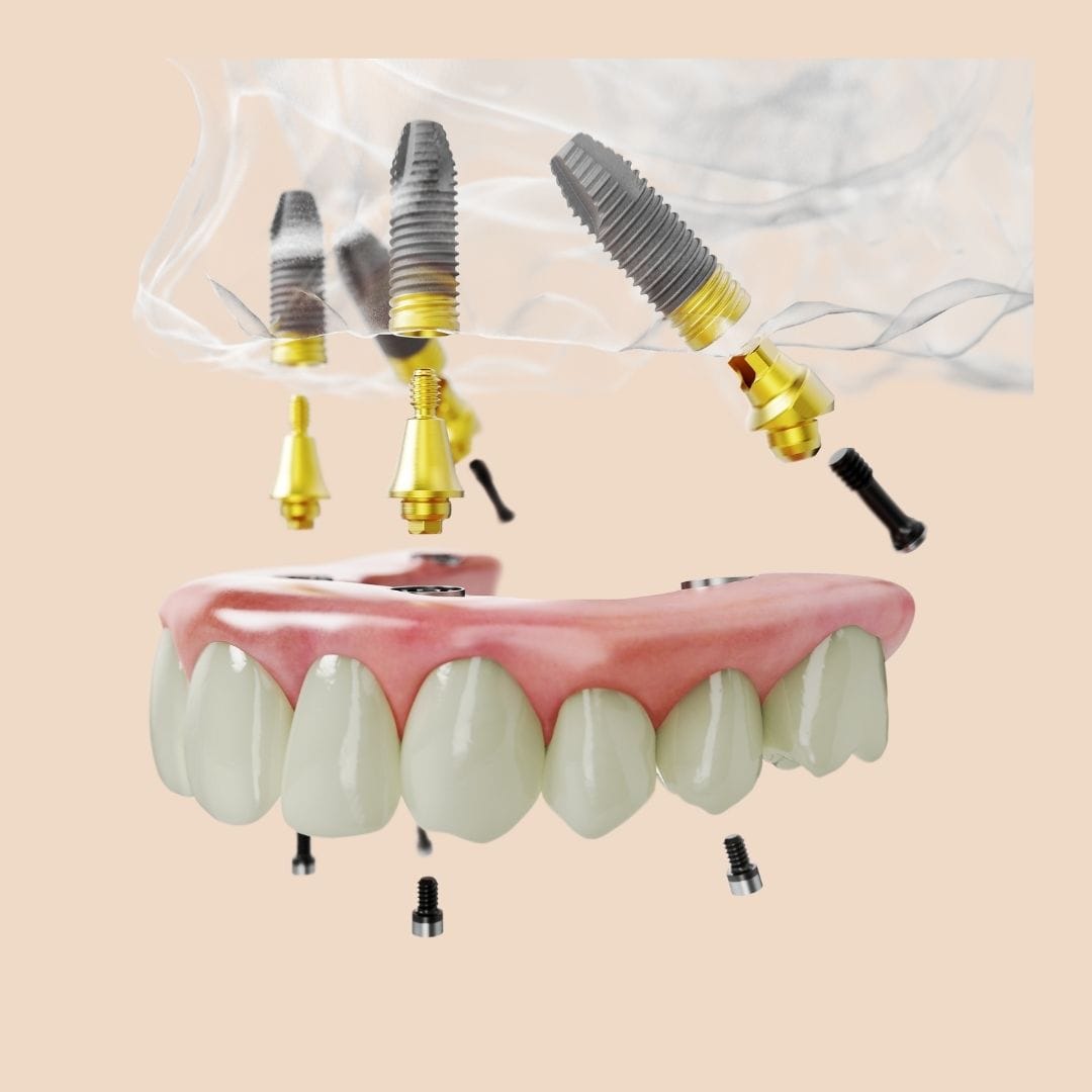 Feature Image - A Guide To All-on-4® Dental Implant Osseointegration