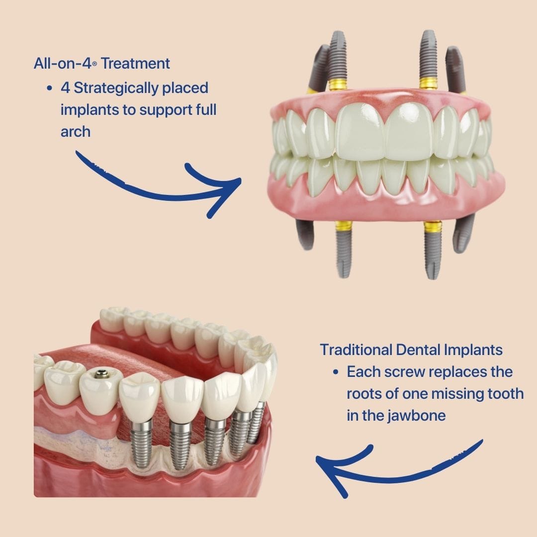 Feature Image - All-on-4® Treatment vs Traditional Dental Implants What’s the Difference