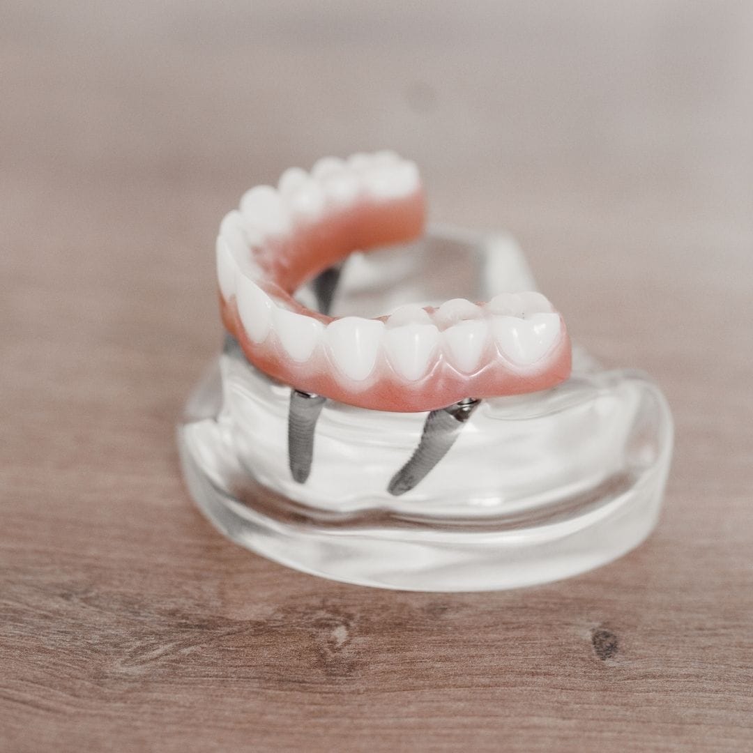 Feature Image Brief History Of Dental Implants & All-on-4®