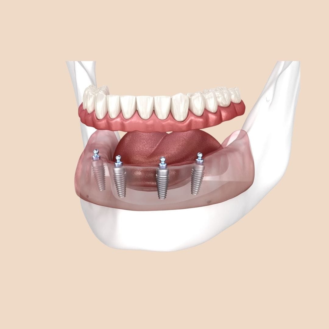 Feature Image - What Are Dental Prosthetics
