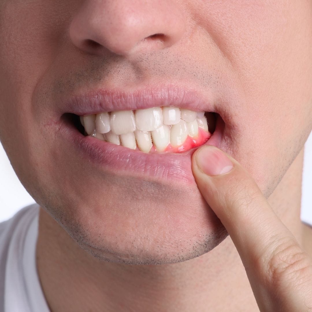 Feature Image - How to Keep Your Gums Healthy