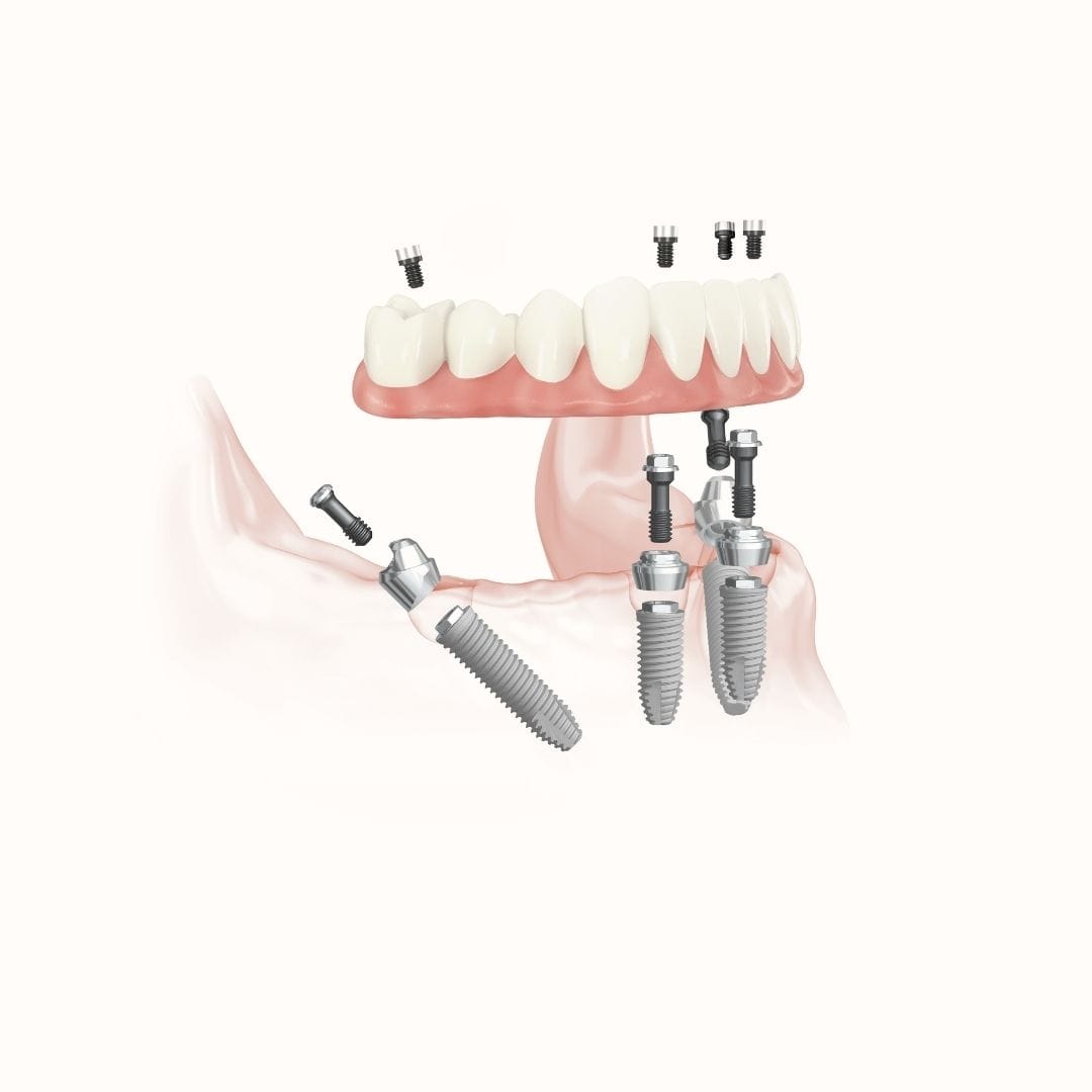 Feature Image - Nobel Speedy Groovy Implants The Bedrock Of All-on-4®