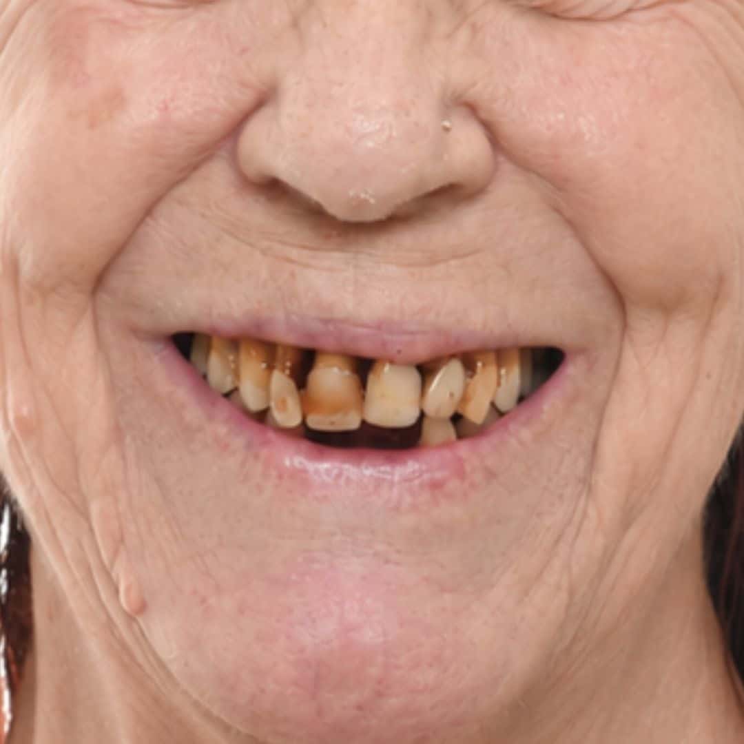 Feature Image - Full-Arch Dental Implants in Perth for Advanced Gum Disease