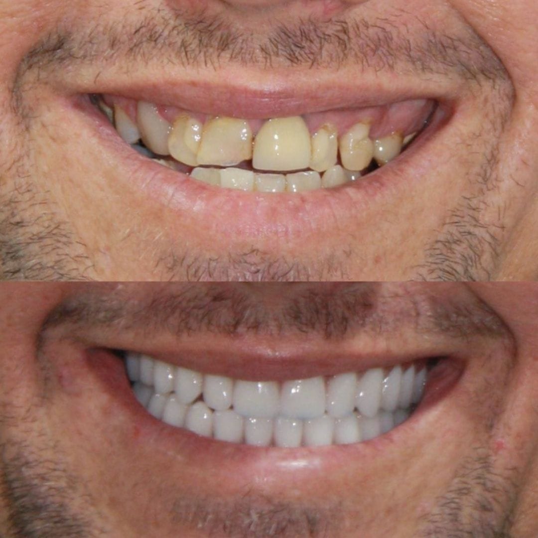 How Full-Arch Dental Implants Fix Failing Teeth