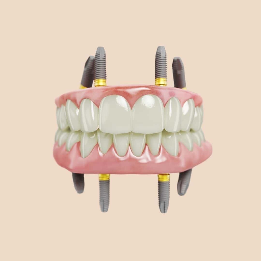 feature image - How to Replace Failing Teeth With All-on-4® Dental Implants in Australia