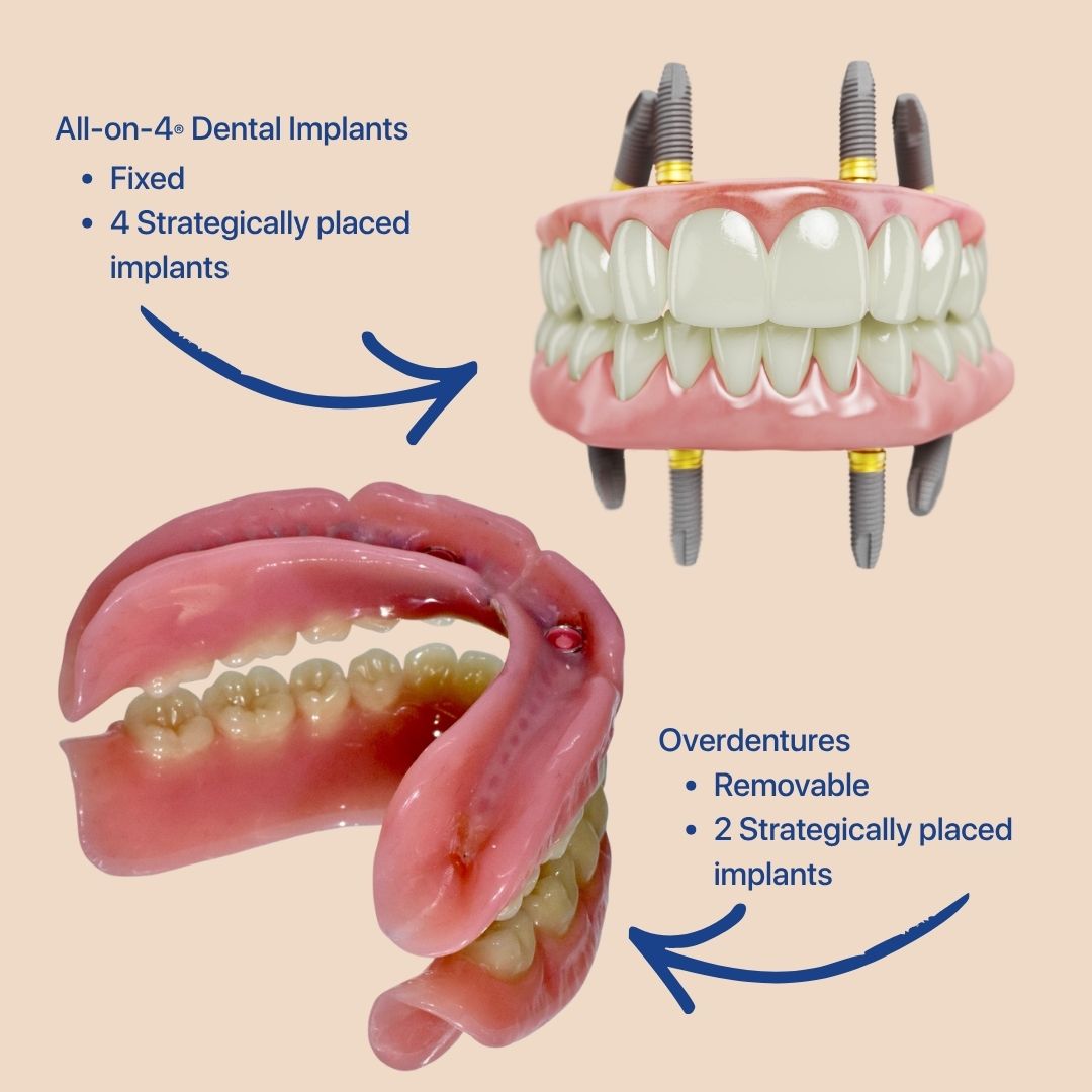 full arch dental implants south australia for Advanced Gum Disease